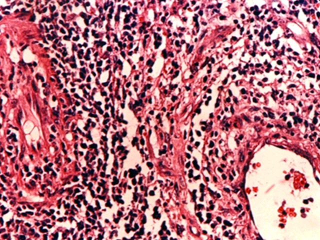 Fig. 23. Linfoma T/NK testicular, caso peditrico. - <div style=